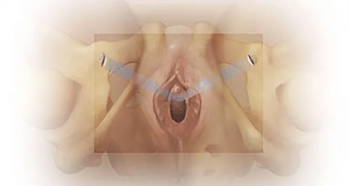 Tension-free vaginal tape (TVT-O) obturator system for Urinary Stress Incontinence.
