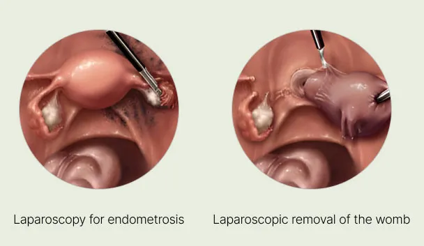 Medical diagram comparing laparoscopy for endometriosis and laparoscopic removal of the womb