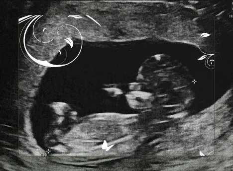 Fetal ultrasound scan showing early development at a pregnancy clinic.